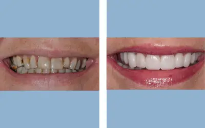 Before and After